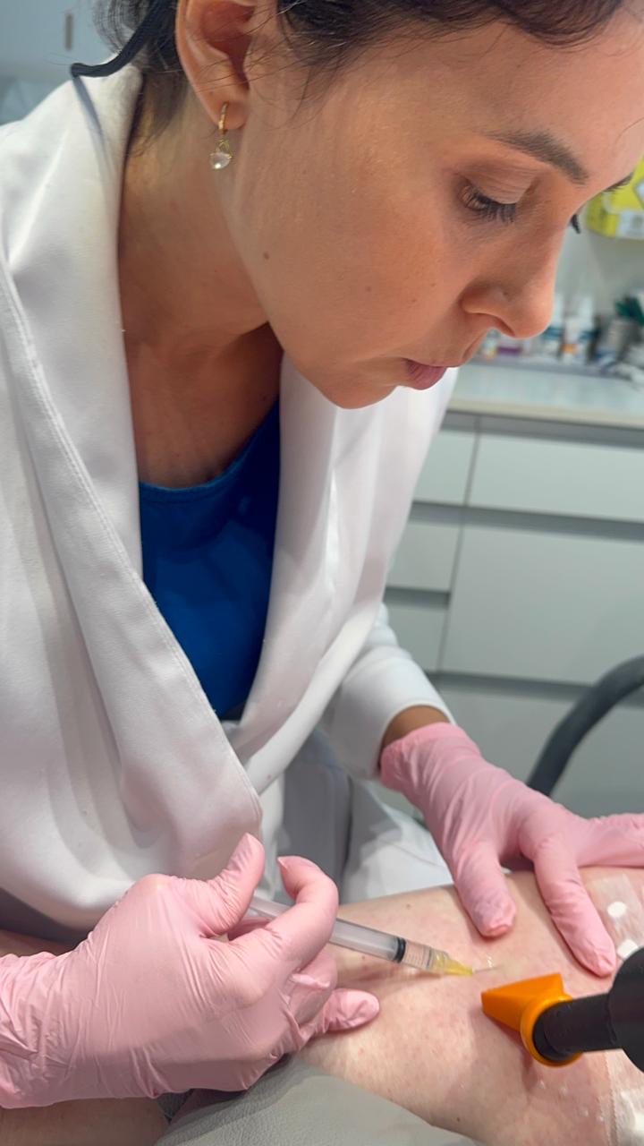 Aplicação de escleroterapia nas pernas